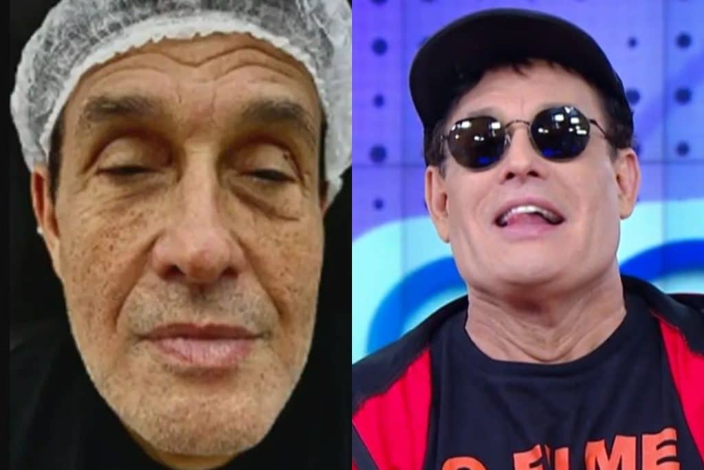 Antes e depois de Sergio Mallandro apos harmonizacao facial